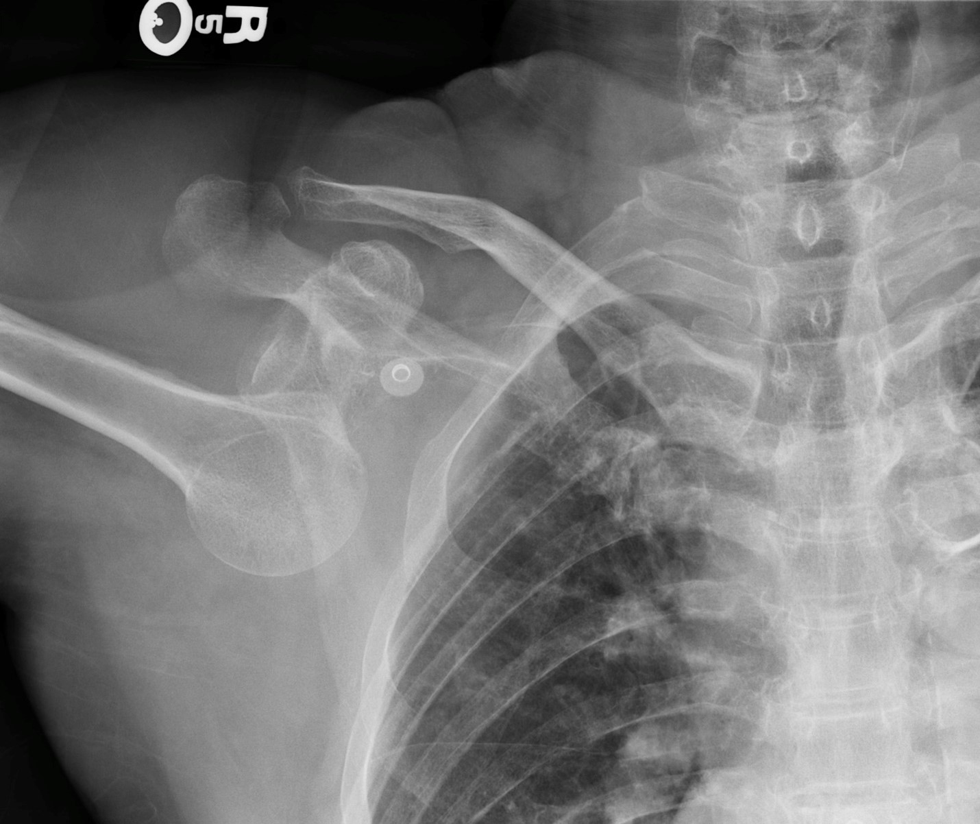 inferior-shoulder-dislocation.jpg