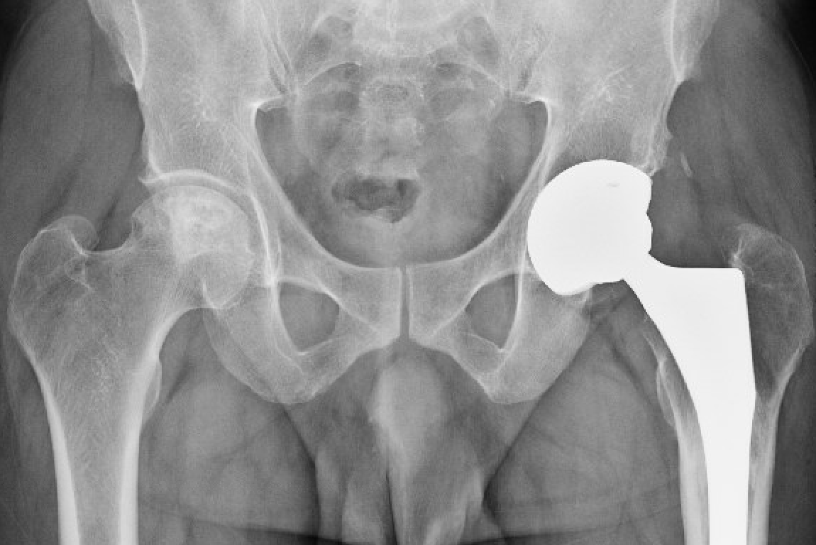 Avascular necrosis of femoral head