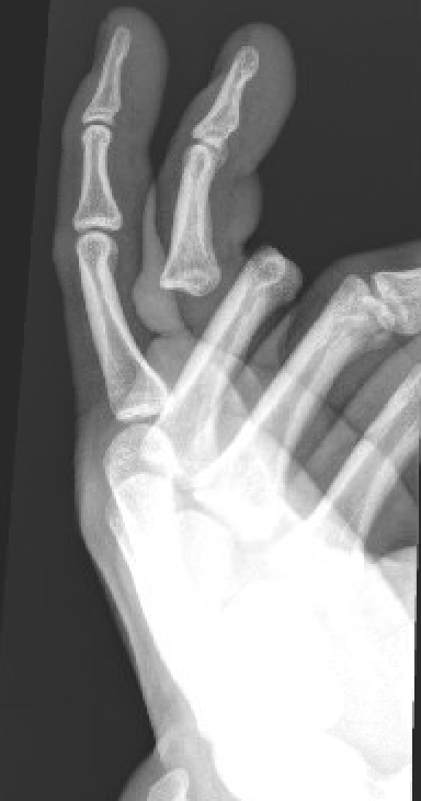open finger dislocation