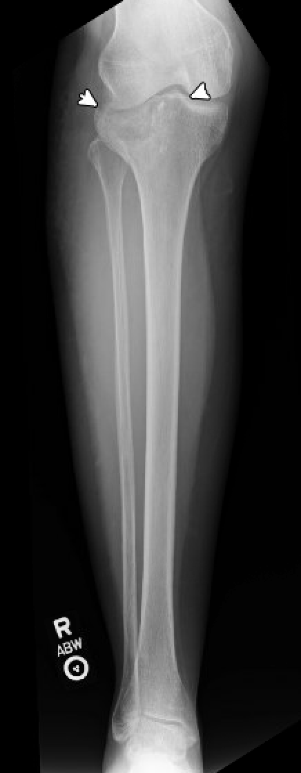 Tibial plateau fracture