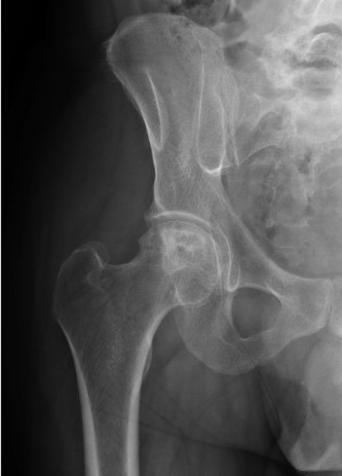Avascular necrosis of femoral head