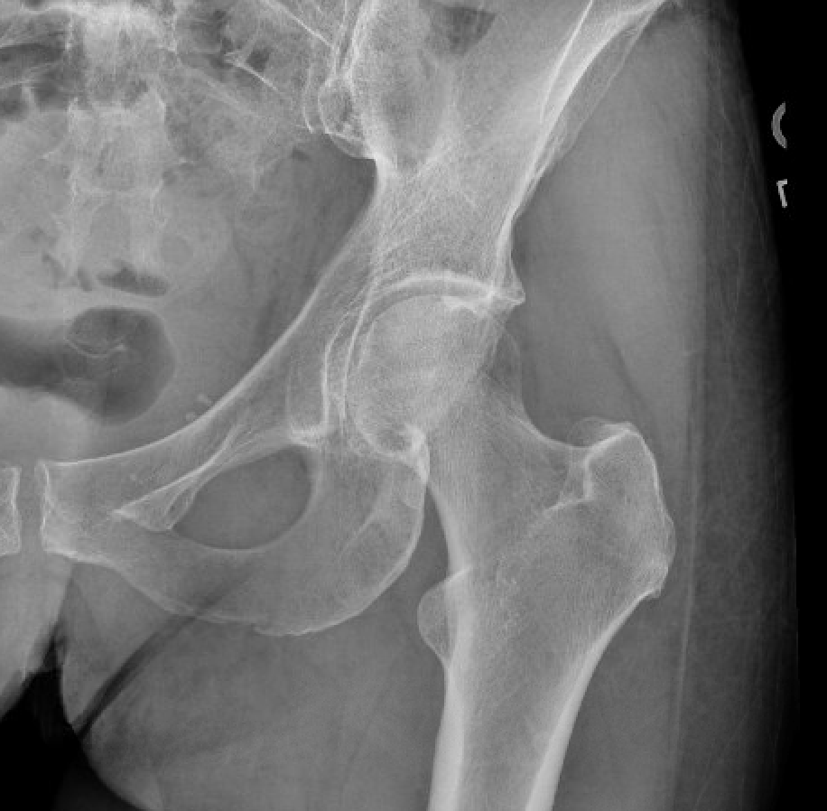 occult hip fracture