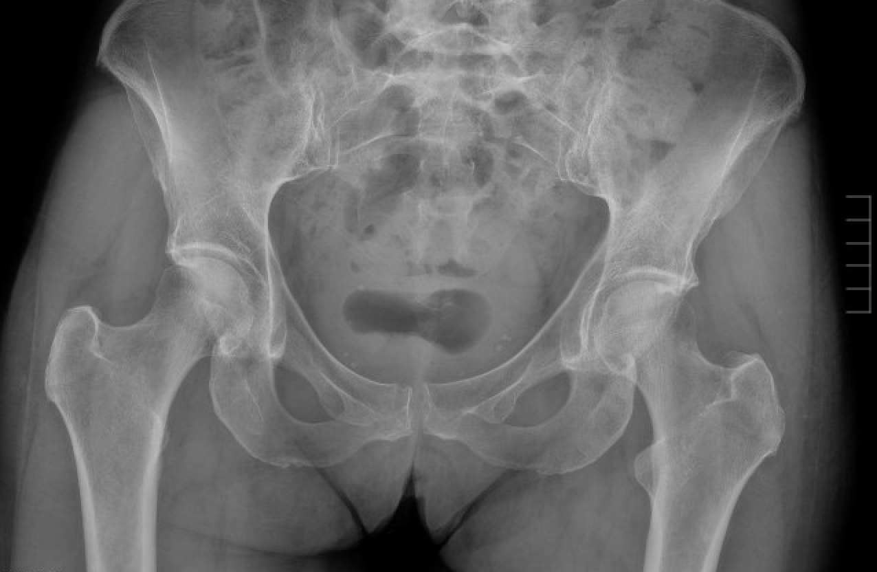 occult hip fracture