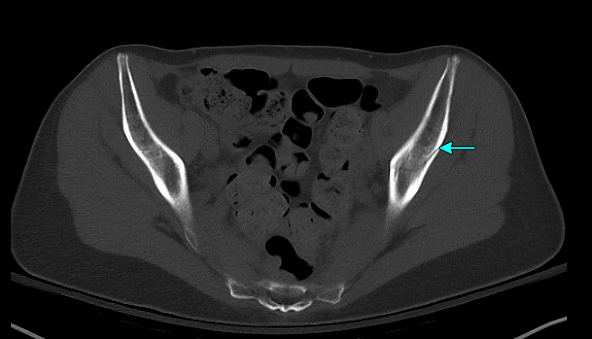 occult hip fracture