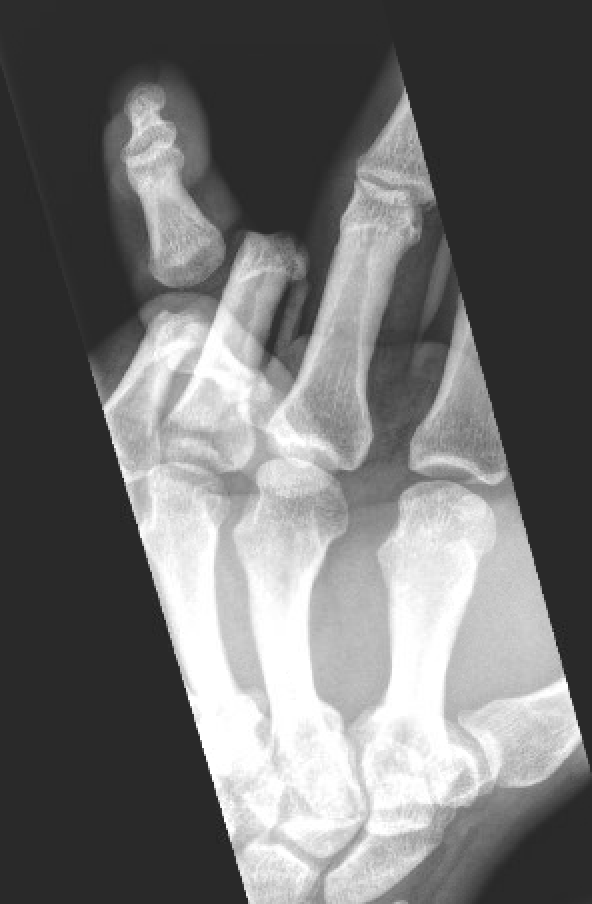 open finger dislocation