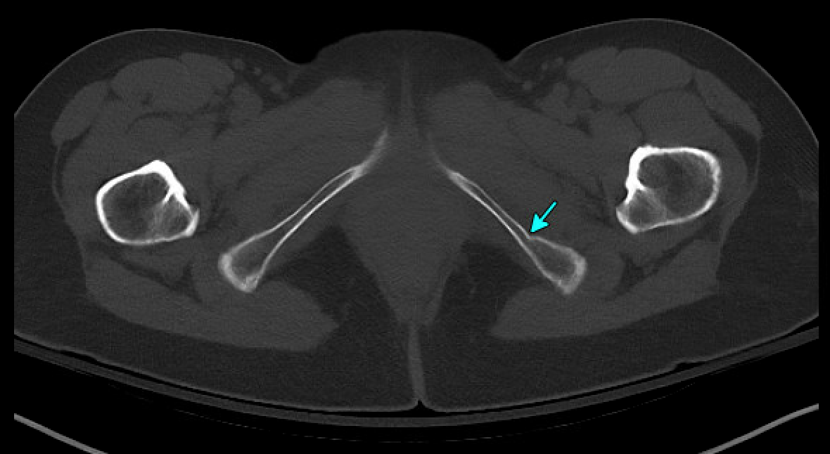 occult hip fracture