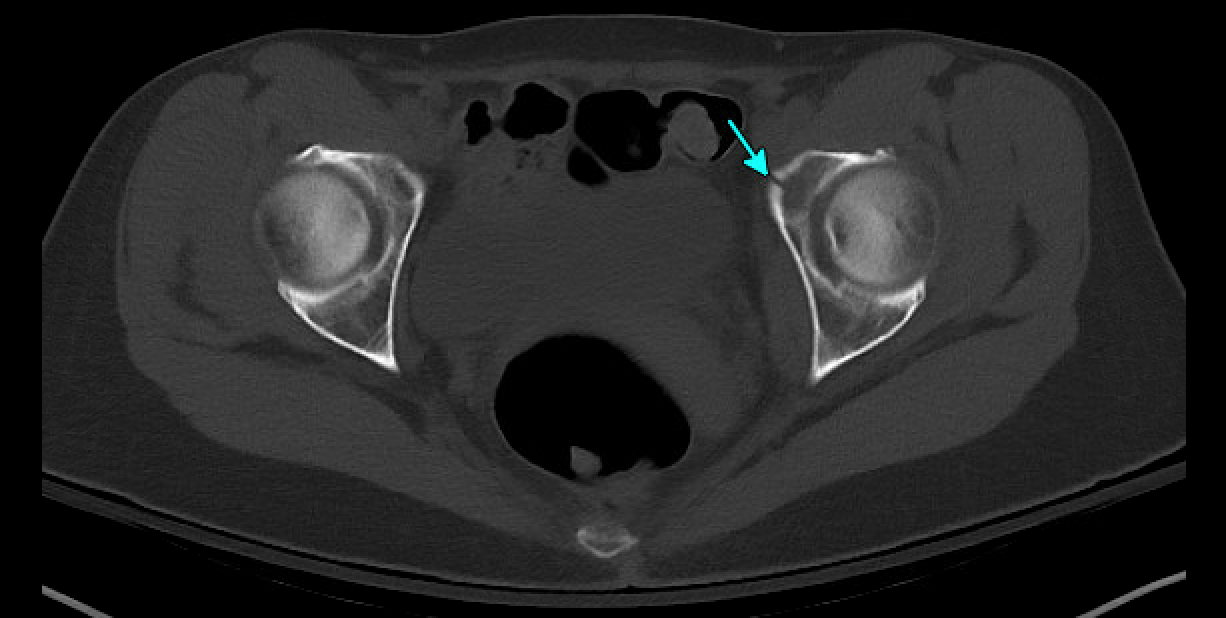 occult hip fracture
