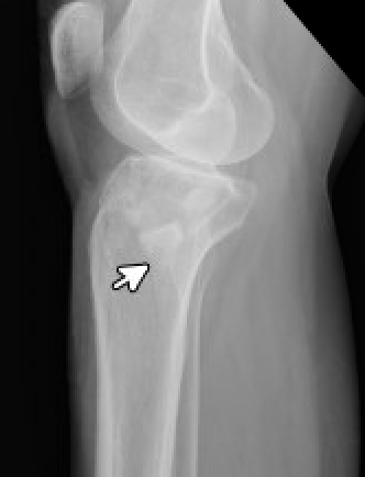 tibial plateau fracture