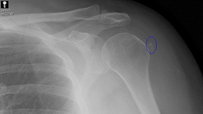 calcific tendonitis