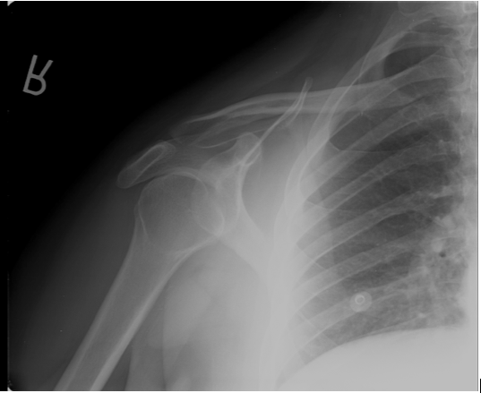 cystic humeral head