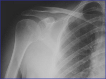 shoulder xray